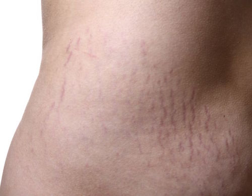What Are Stretch Marks?