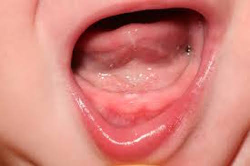 9. Gums Are Red And Raw